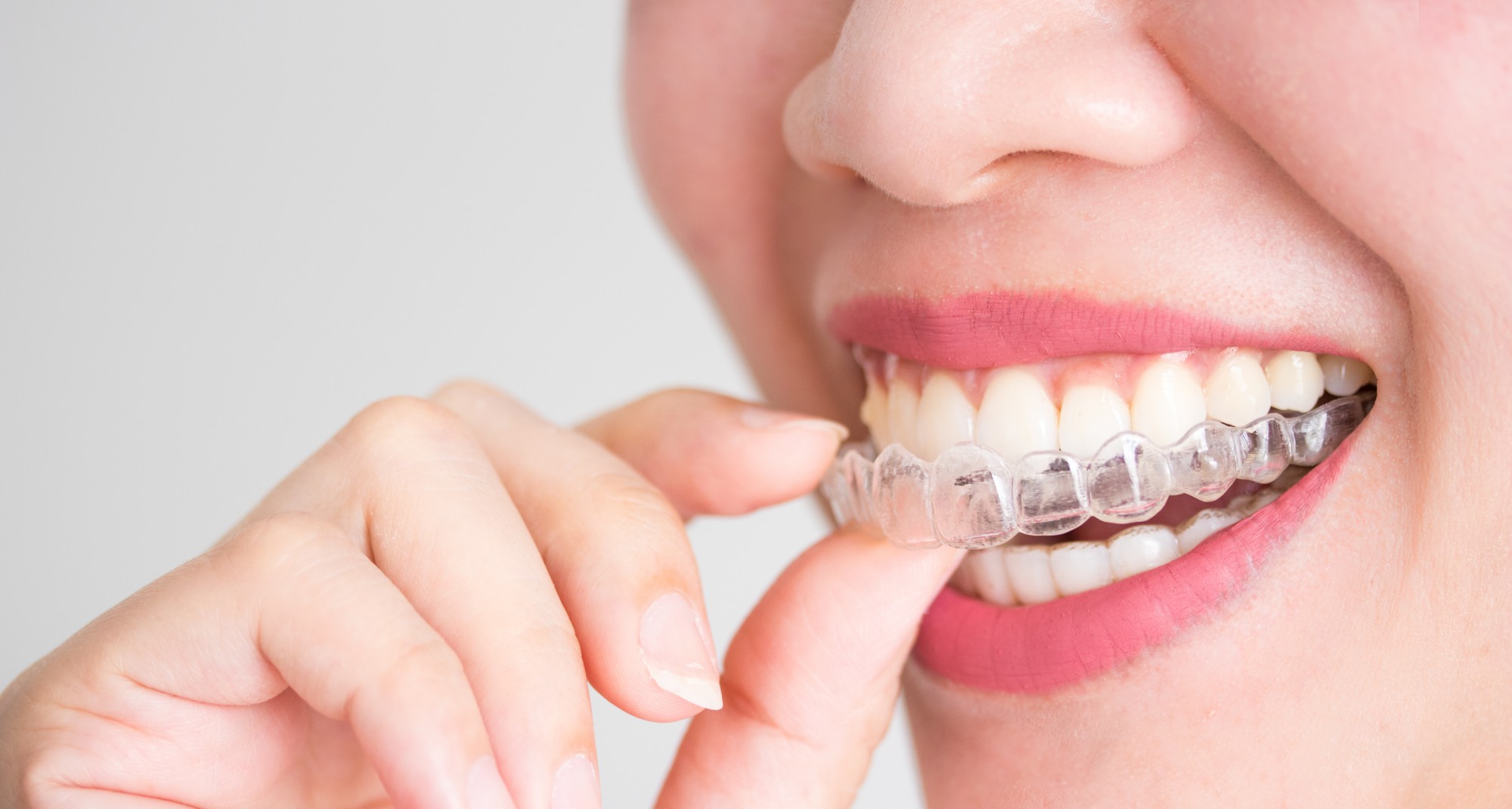 Invisalign