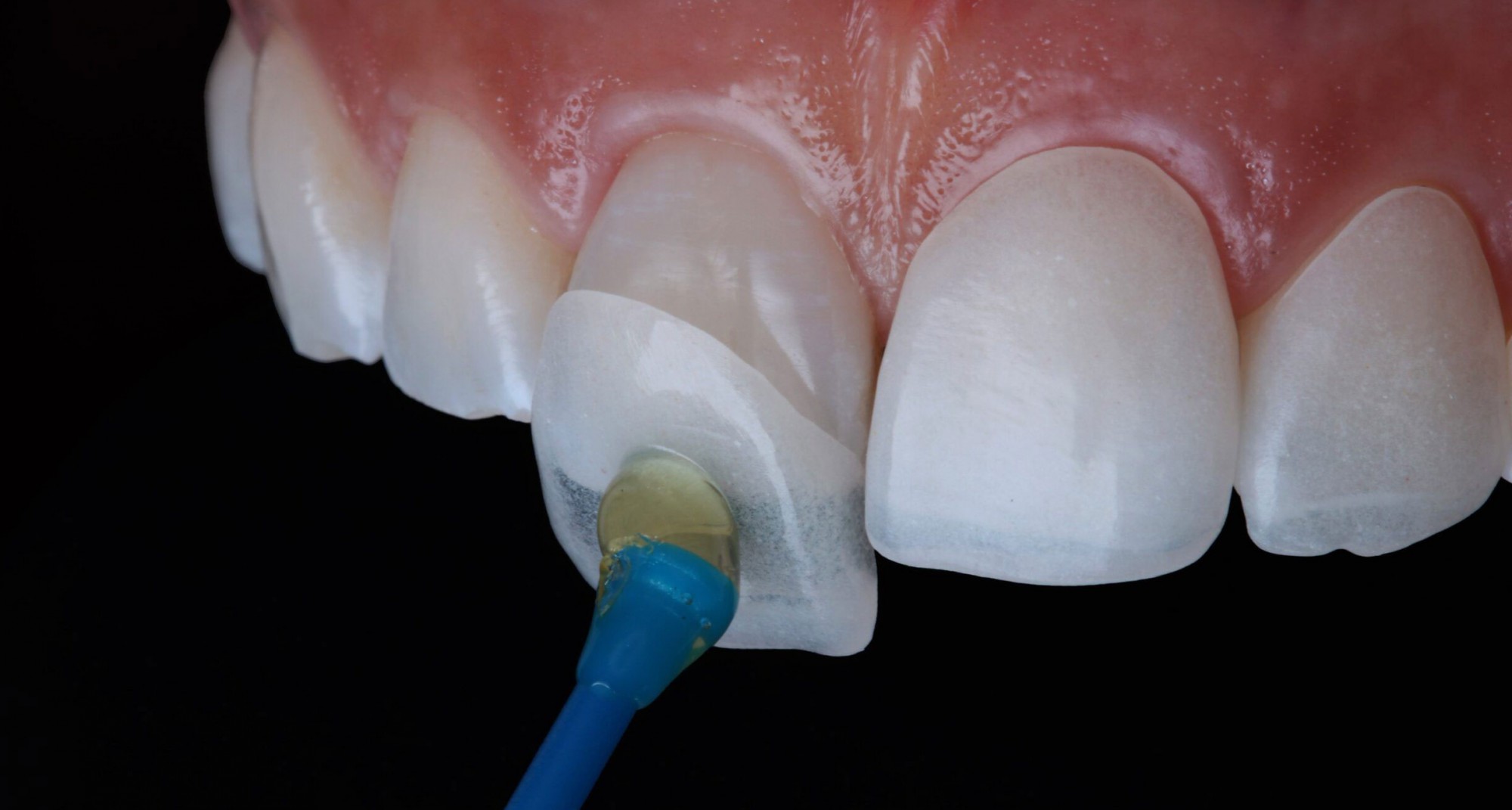 Faccette dentali: cosa sono, i costi e i vantaggi