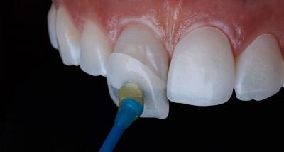 Faccette dentali: cosa sono, i costi e i vantaggi